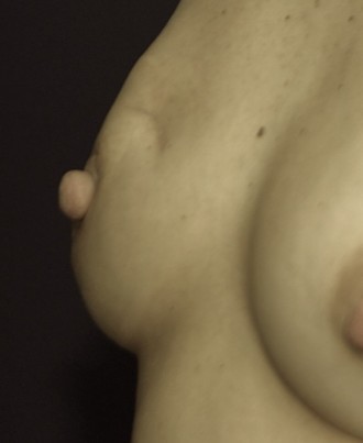 Lumpectomy and Radiation performed