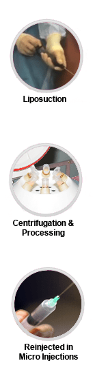 fat grafting process steps diagram